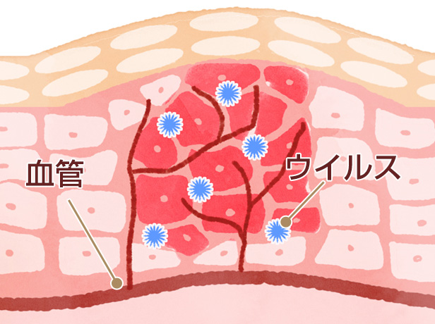 いぼの特徴 図